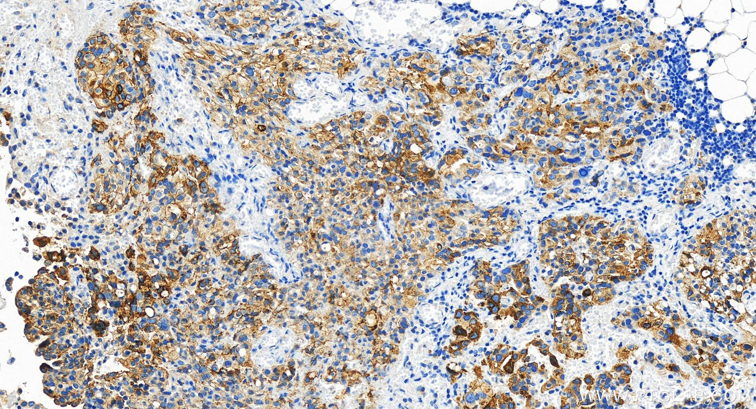 IHC staining of human ovary cancer using 29856-1-AP