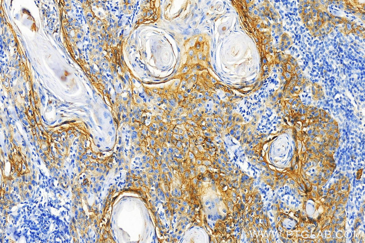 IHC staining of human skin cancer using 29856-1-AP