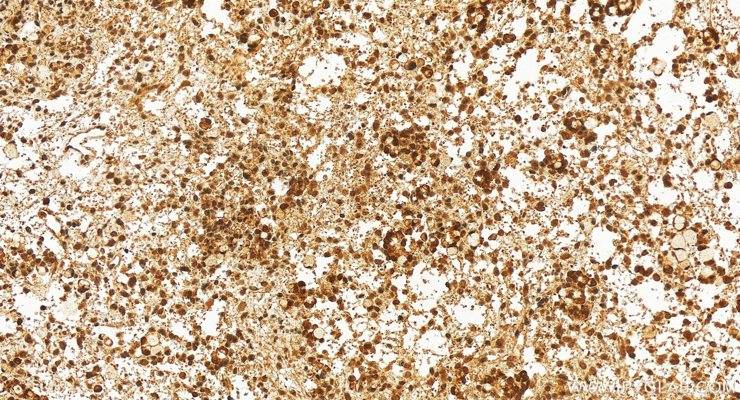 IHC staining of human ovary cancer using 17367-1-AP