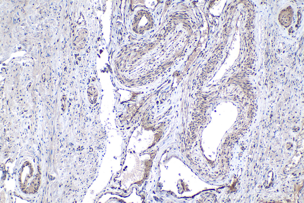 IHC staining of human cervical cancer using 24235-1-AP