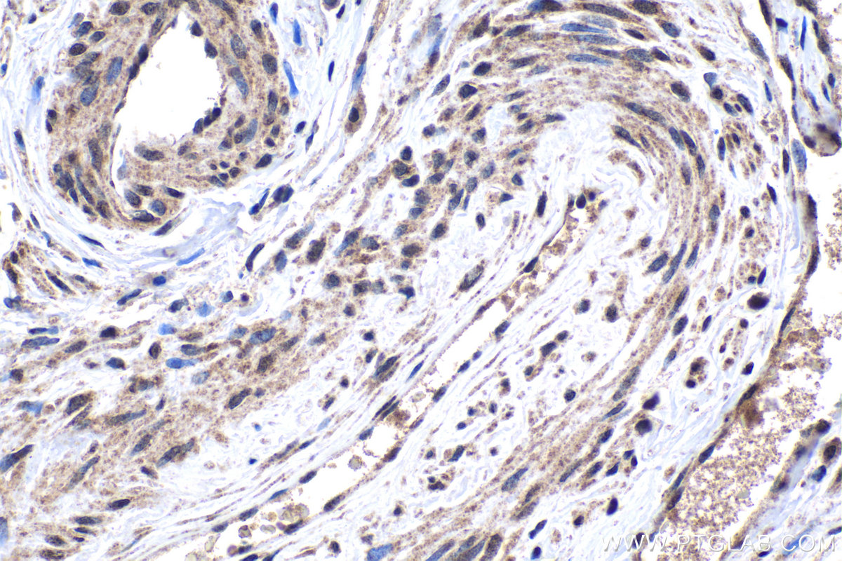 IHC staining of human cervical cancer using 24235-1-AP