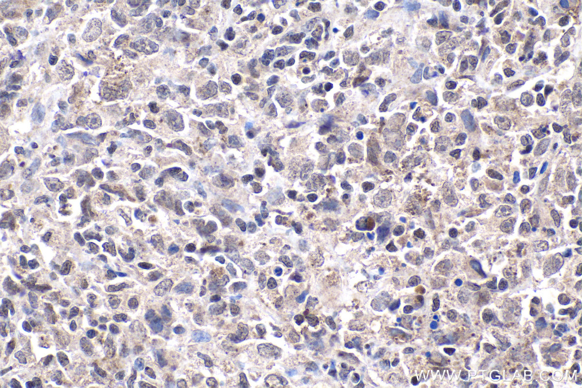 IHC staining of human malignant melanoma using 24235-1-AP