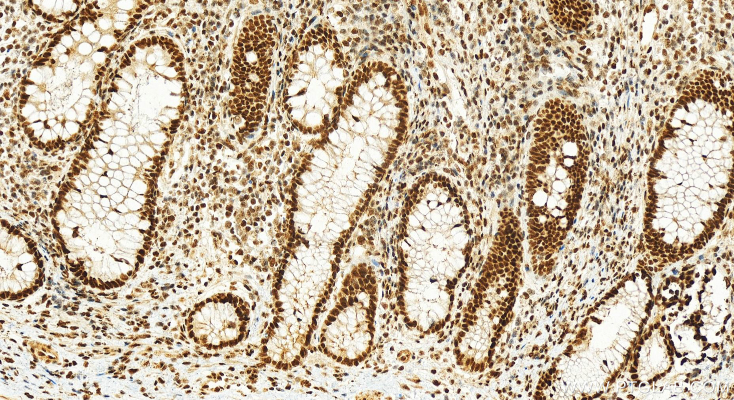 IHC staining of human colon cancer using 25521-1-AP