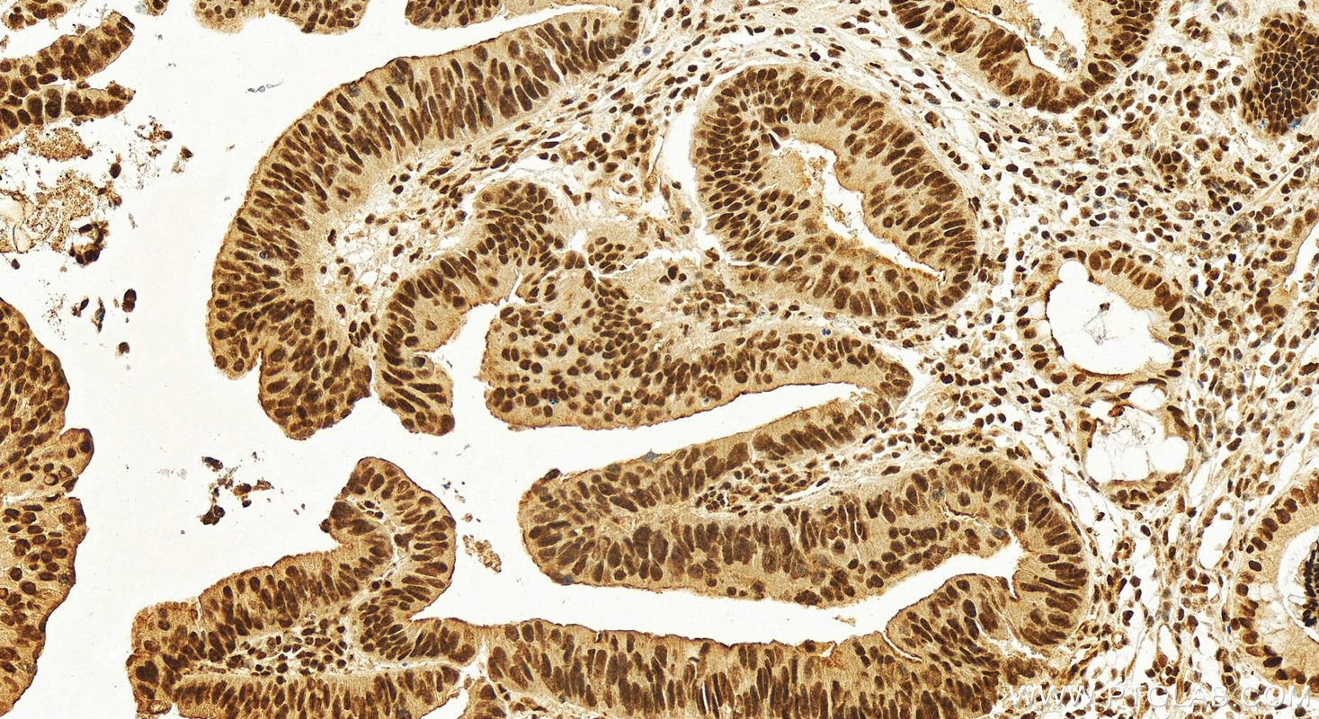 IHC staining of human colon cancer using 25521-1-AP