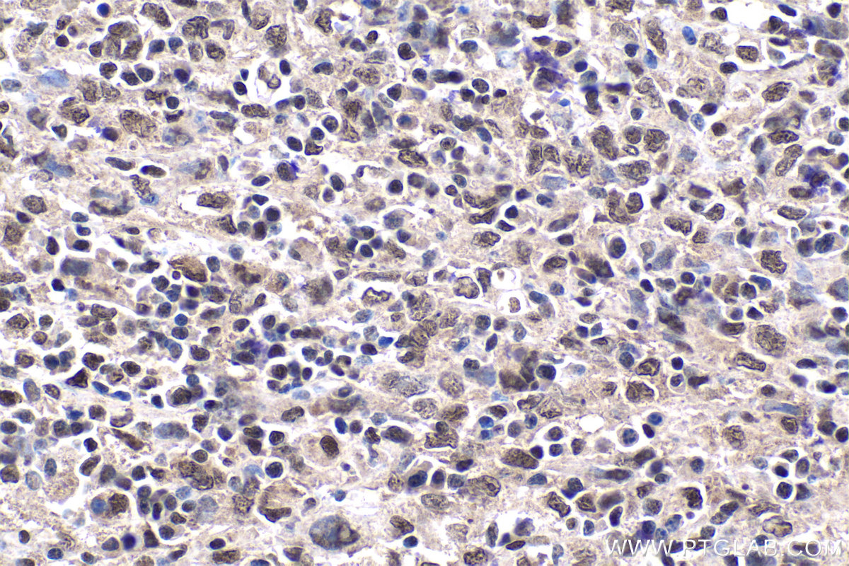 IHC staining of human malignant melanoma using 25521-1-AP