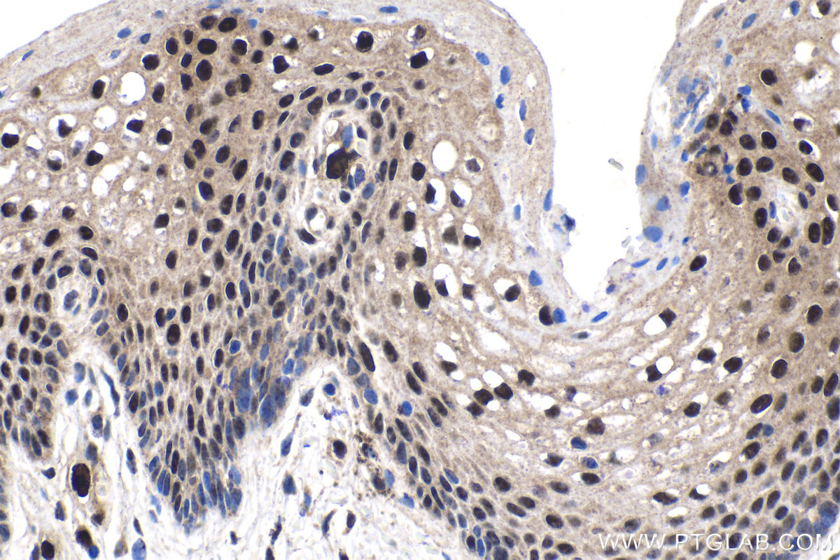 IHC staining of human cervical cancer using 25521-1-AP