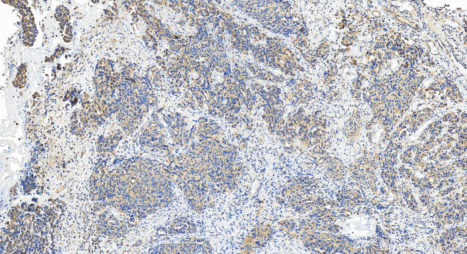 IHC staining of human ovary cancer using 10234-2-AP