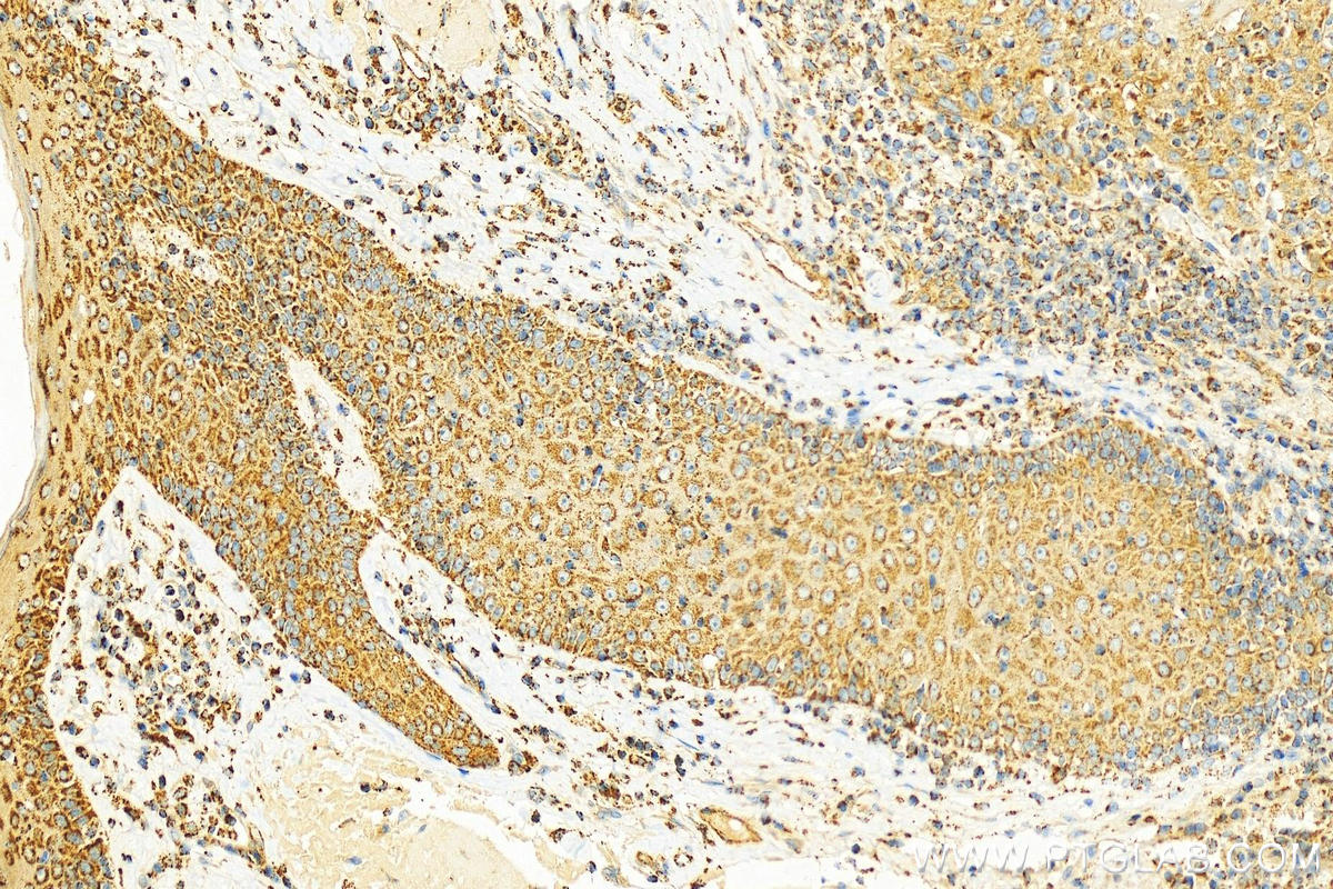 IHC staining of human skin cancer using 10234-2-AP