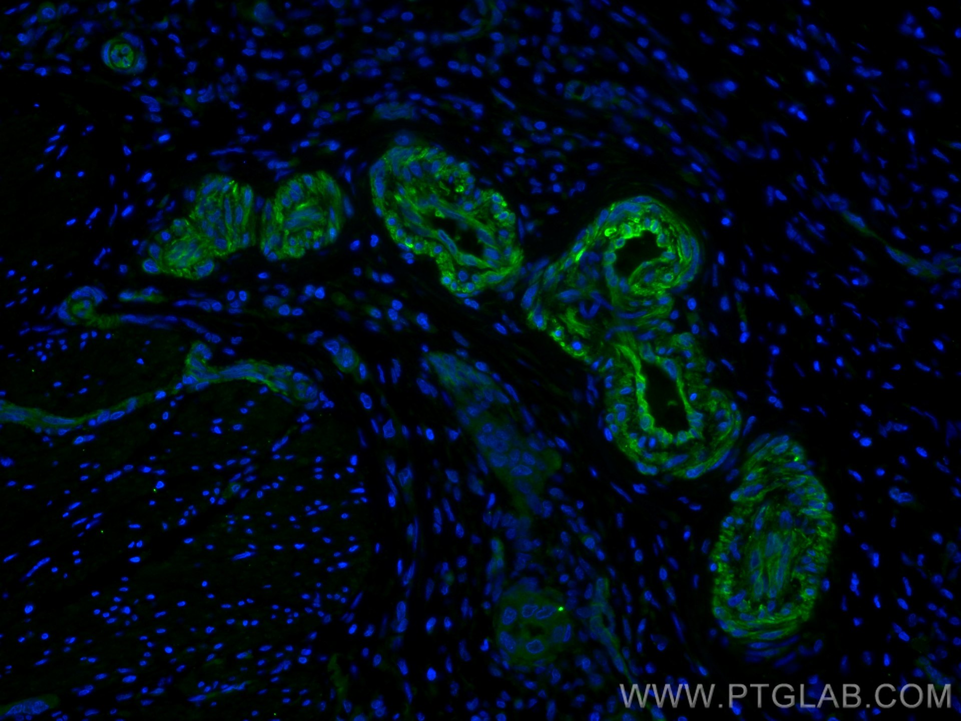 IF Staining of human colon cancer using 60044-1-Ig (same clone as 60044-1-PBS)