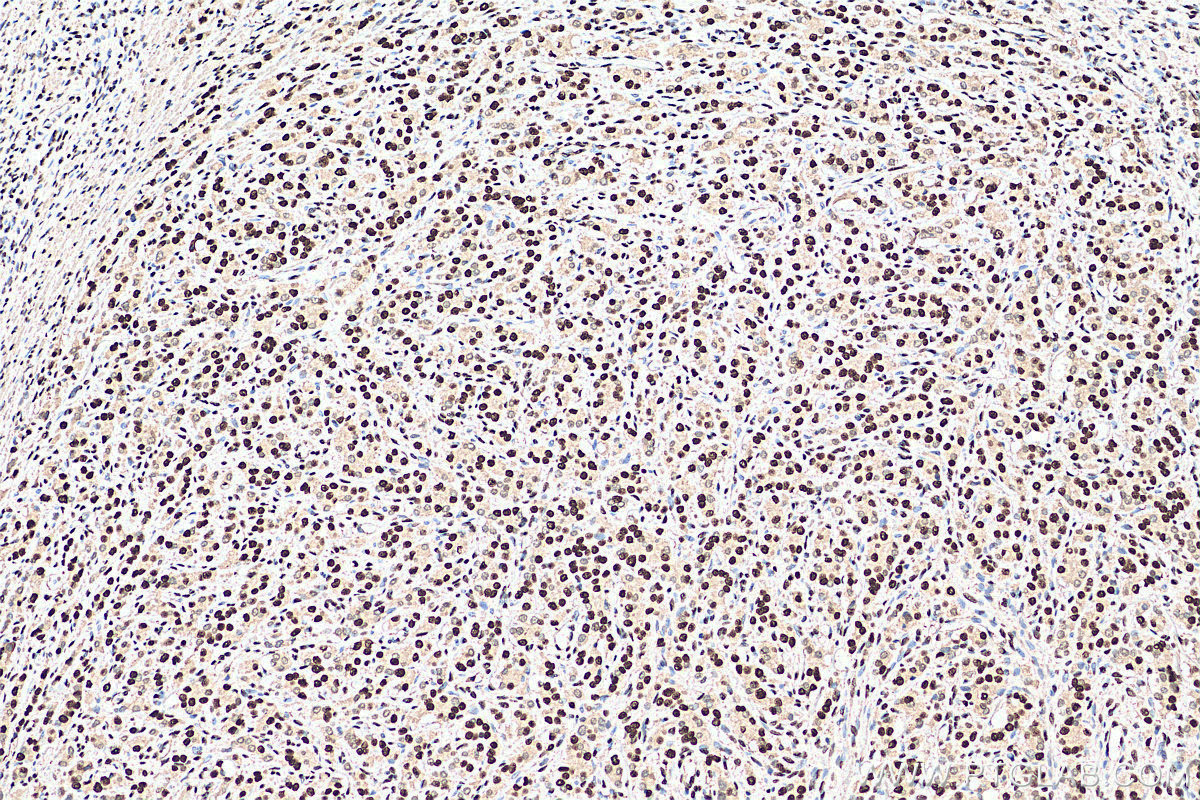 IHC staining of human prostate cancer using 67816-1-Ig