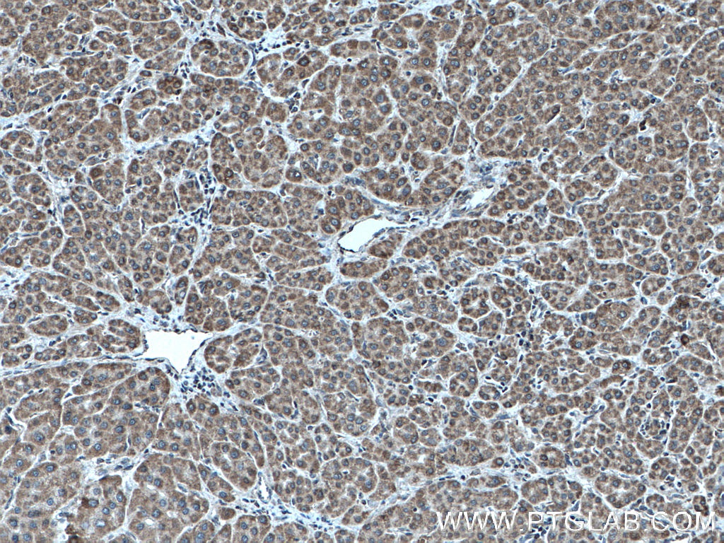 IHC staining of human liver cancer using 27657-1-AP