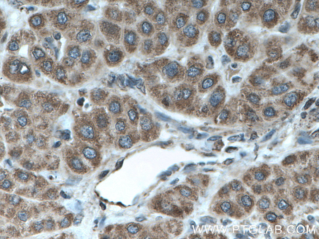 IHC staining of human liver cancer using 27657-1-AP