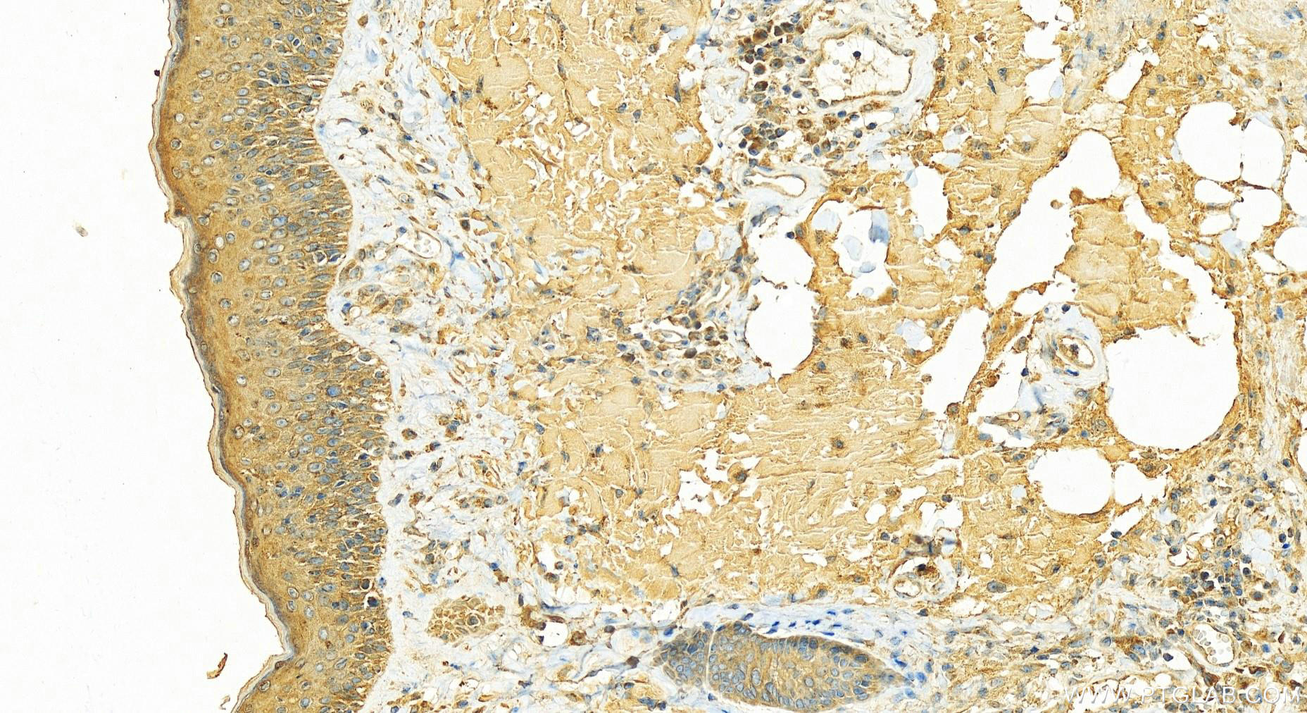 IHC staining of human skin cancer using 14424-1-AP