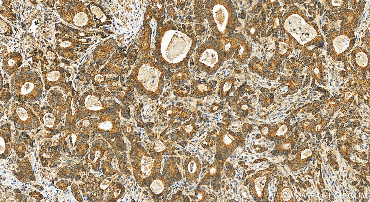 IHC staining of human stomach cancer using 10177-2-AP