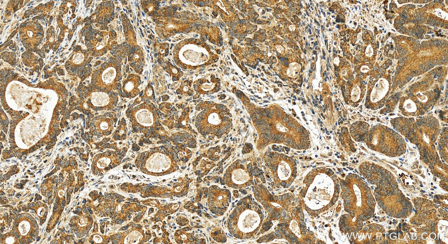 IHC staining of human stomach cancer using 10177-2-AP