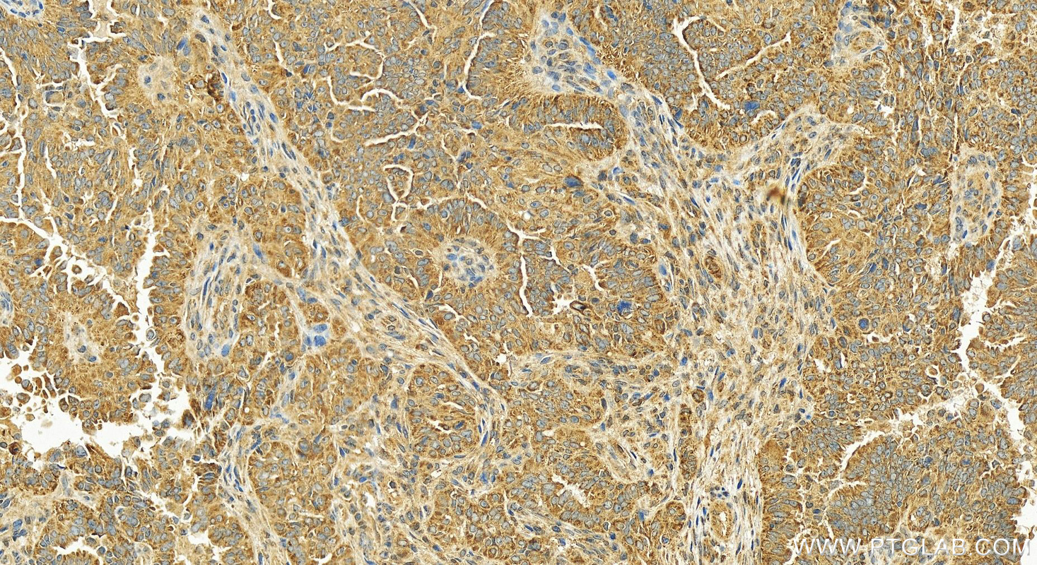 IHC staining of human ovary cancer using 10177-2-AP