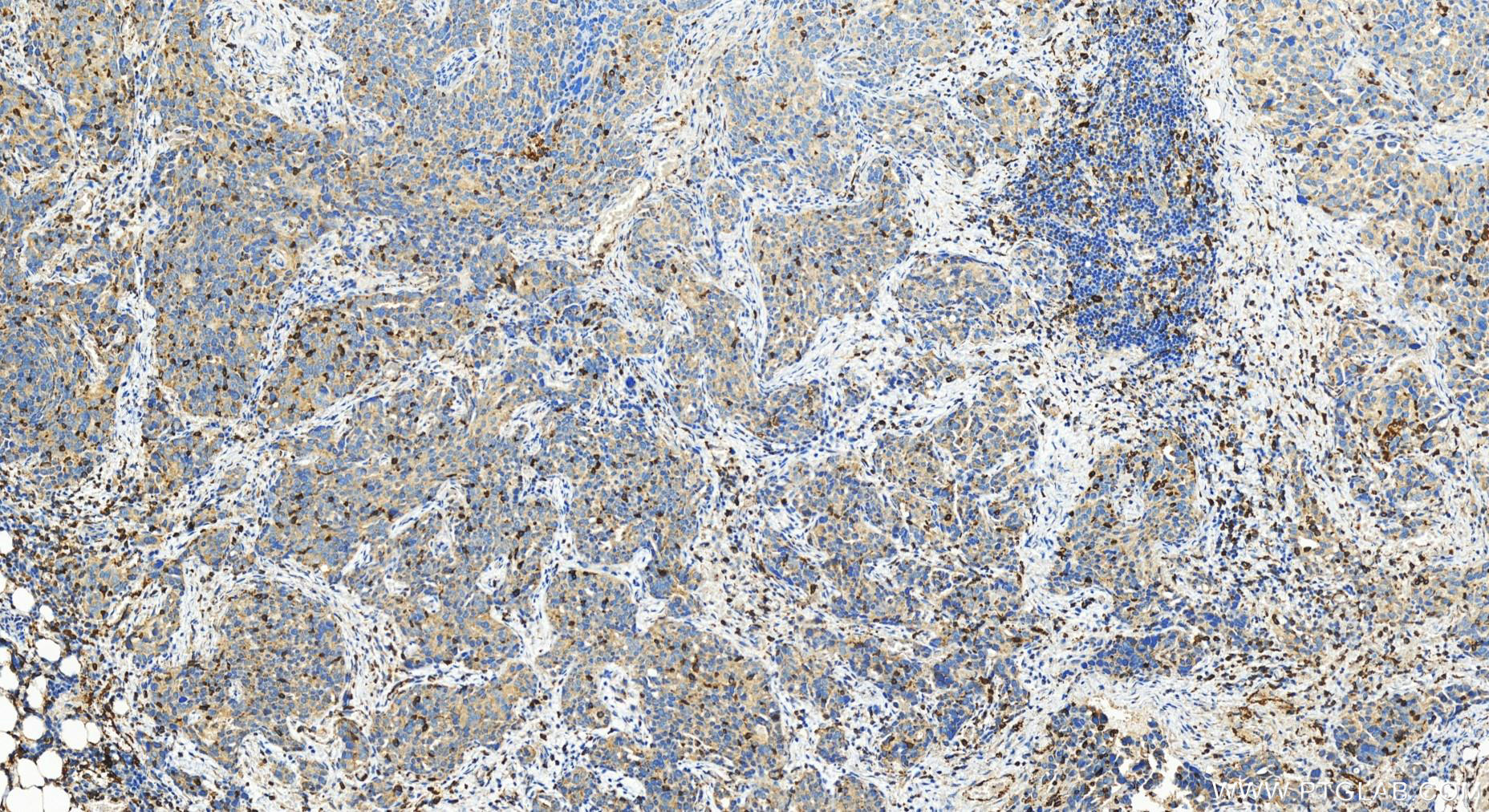 IHC staining of human ovary cancer using 30215-1-AP