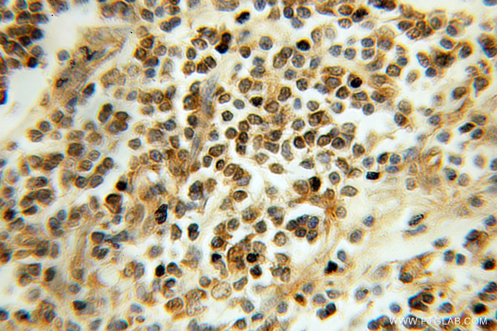 IHC staining of human colon cancer using 10779-1-AP