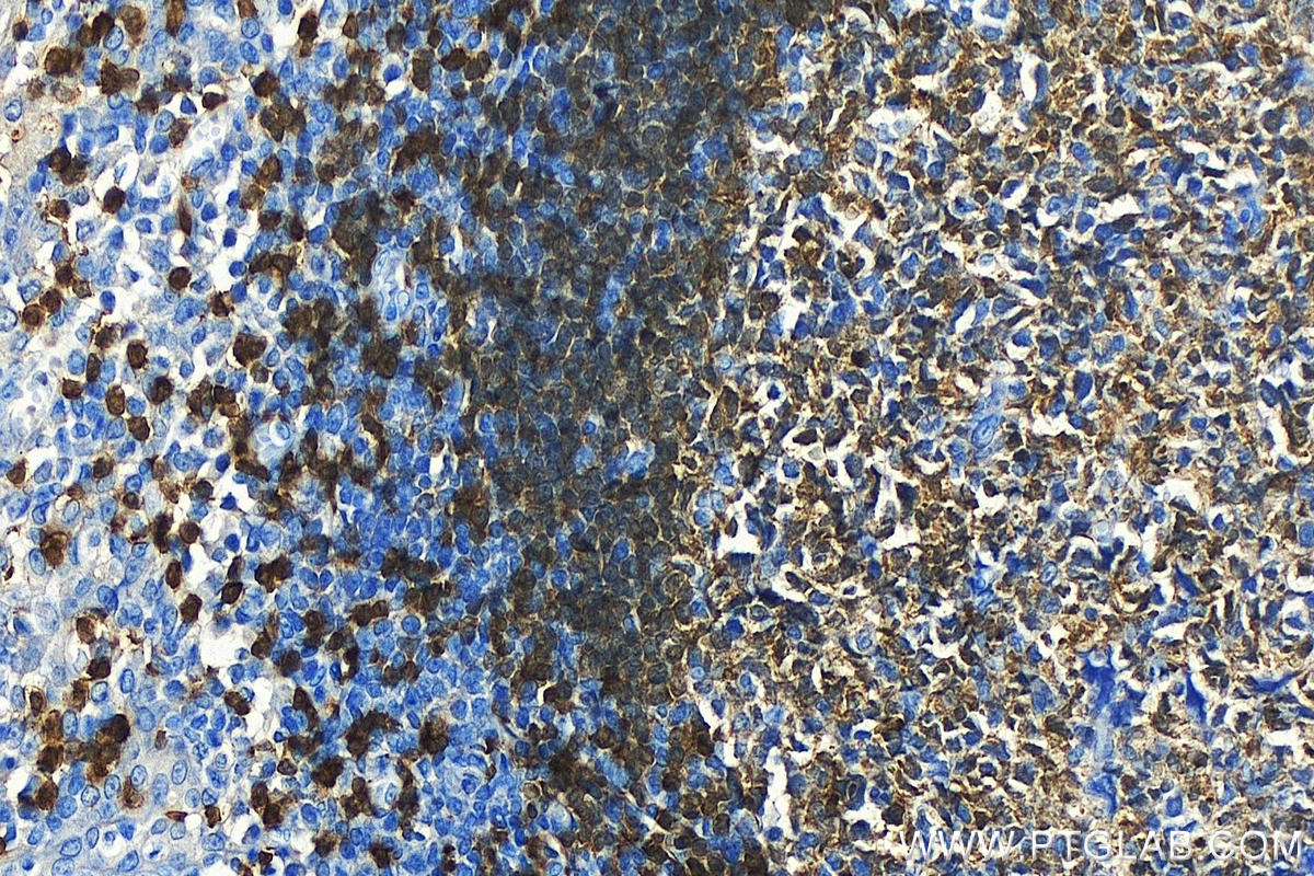 IHC staining of human tonsillitis using 10475-1-AP