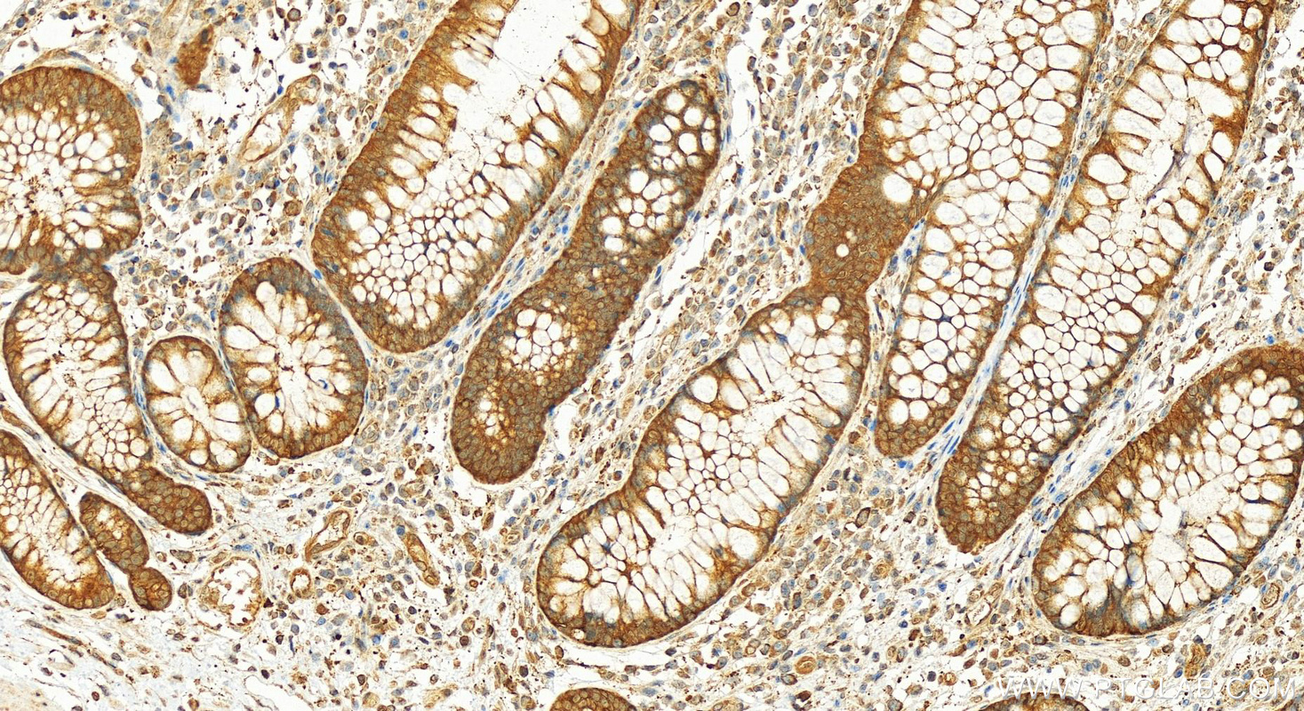 IHC staining of human colon cancer using 10320-1-AP