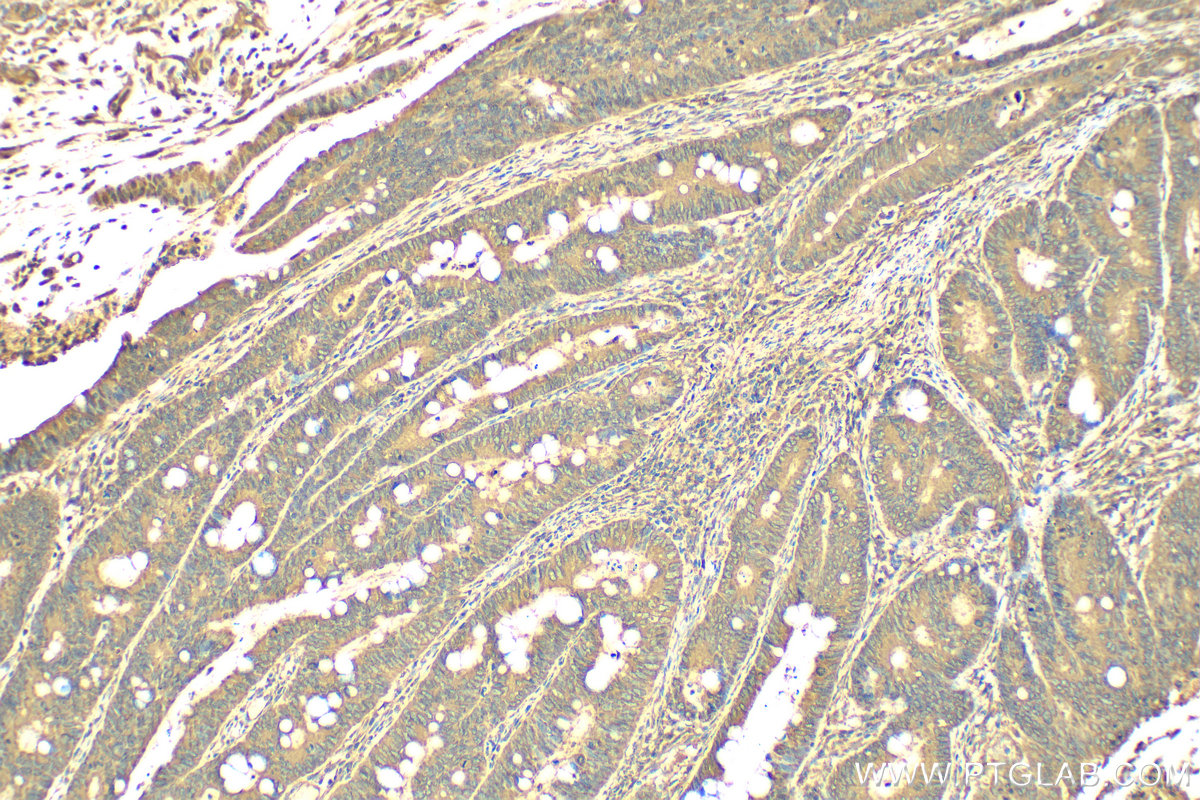 IHC staining of human colon cancer using 82120-1-RR