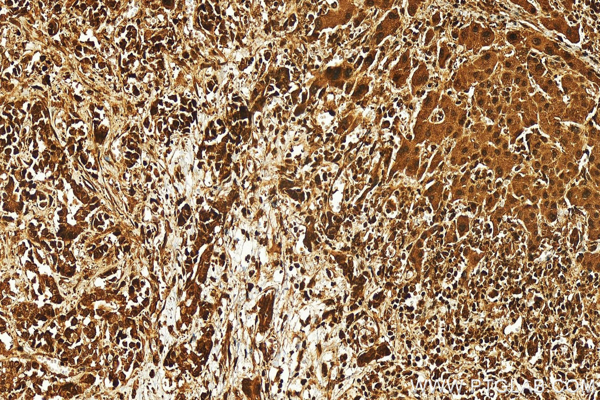 IHC staining of human intrahepatic cholangiocarcinoma using 10641-1-AP