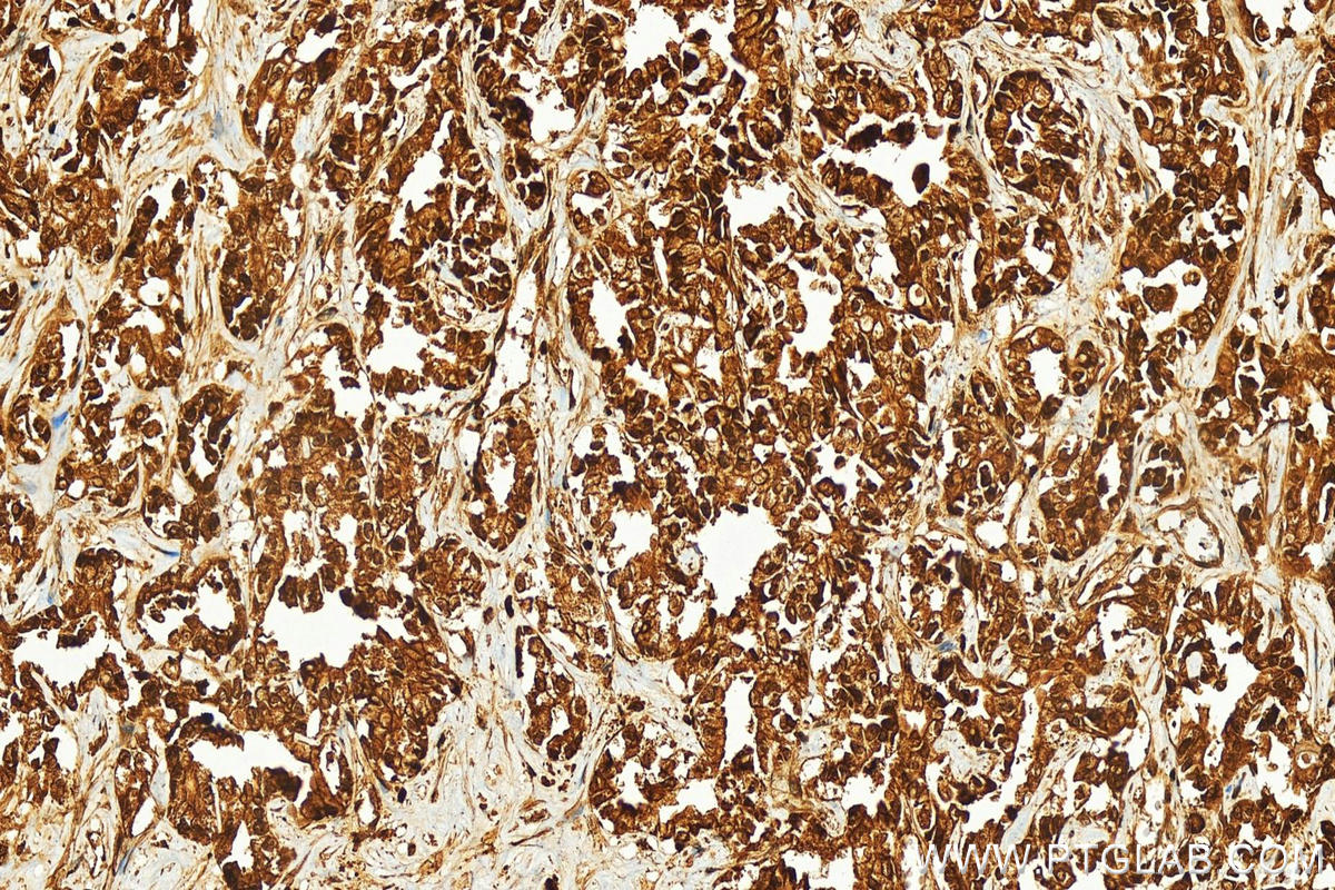 IHC staining of human intrahepatic cholangiocarcinoma using 10641-1-AP