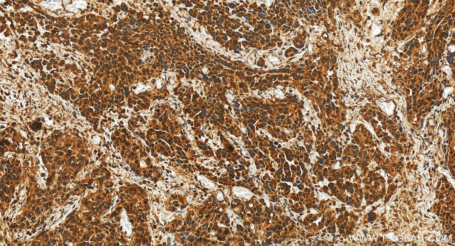 IHC staining of human ovary cancer using 10641-1-AP