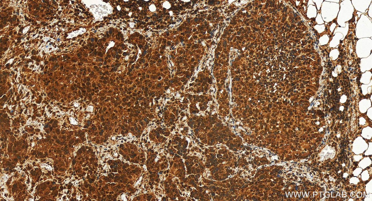 IHC staining of human ovary cancer using 10641-1-AP