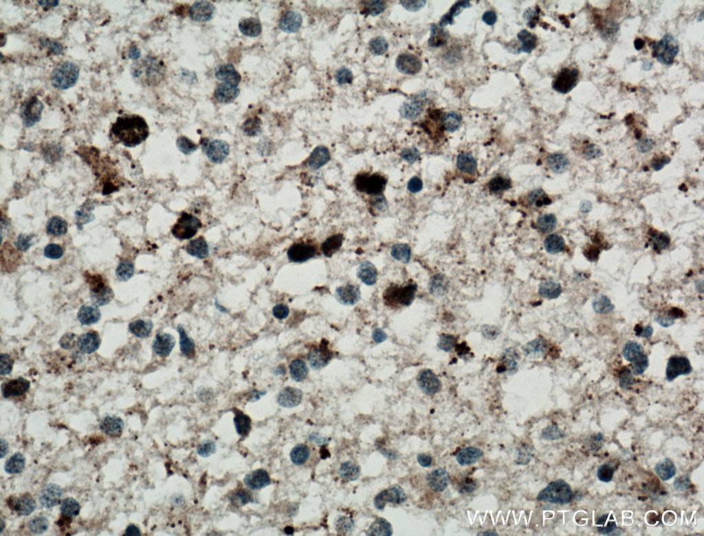 IHC staining of human gliomas using 11899-1-AP