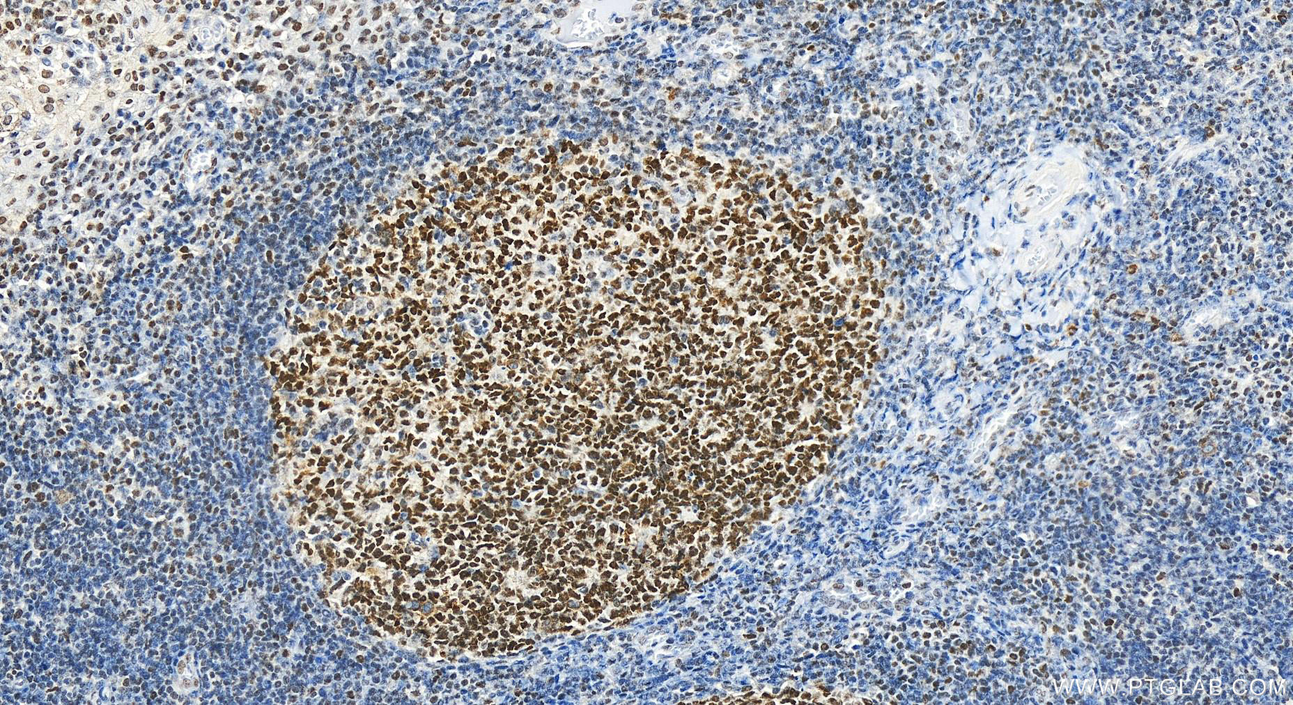 IHC staining of human tonsillitis using 14595-1-AP