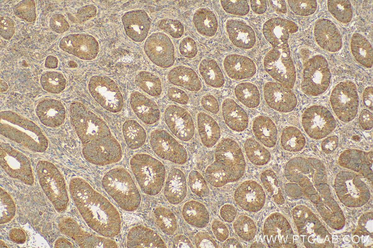 IHC staining of human colon cancer using 13734-1-AP