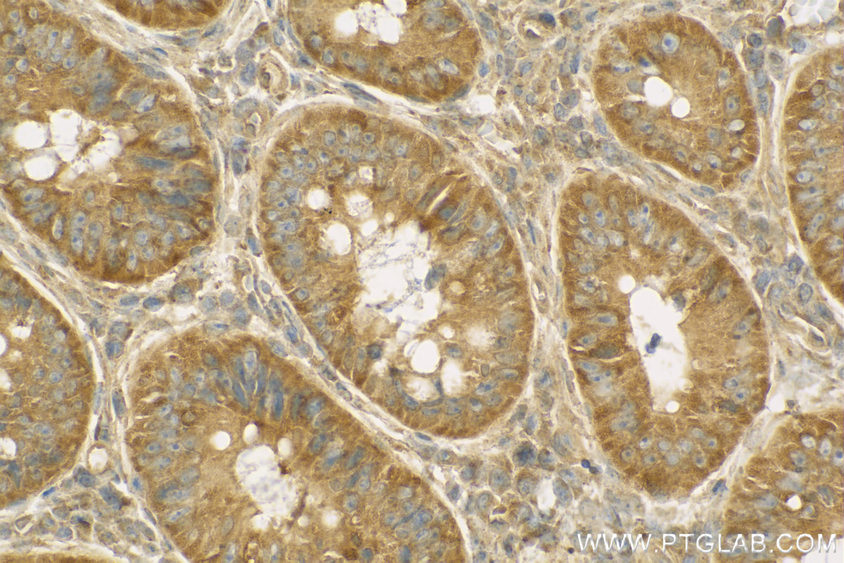 IHC staining of human colon cancer using 13734-1-AP