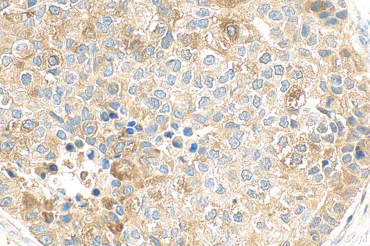 IHC staining of human stomach cancer using 13734-1-AP