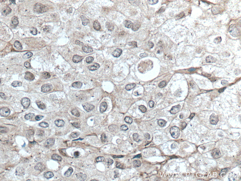 IHC staining of human breast cancer using 66916-1-Ig (same clone as 66916-1-PBS)