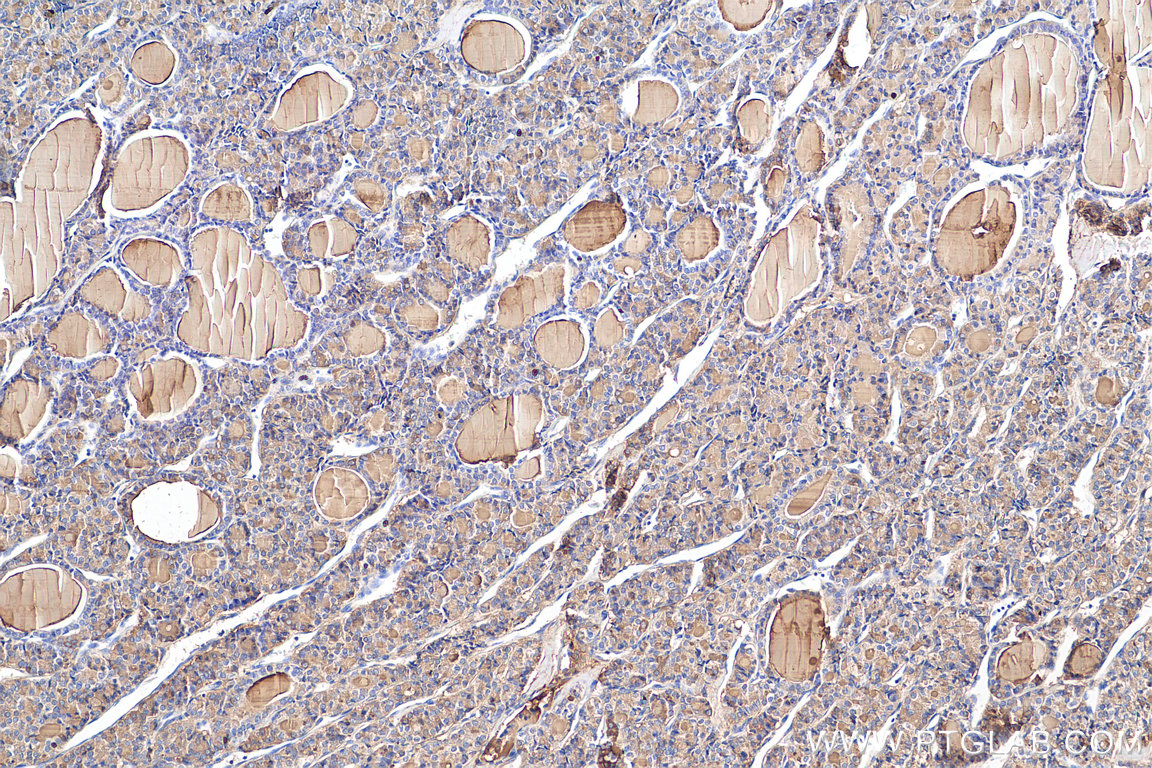 IHC staining of human thyroid cancer using 21714-1-AP