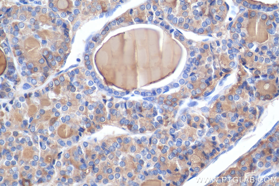 IHC staining of human thyroid cancer using 21714-1-AP