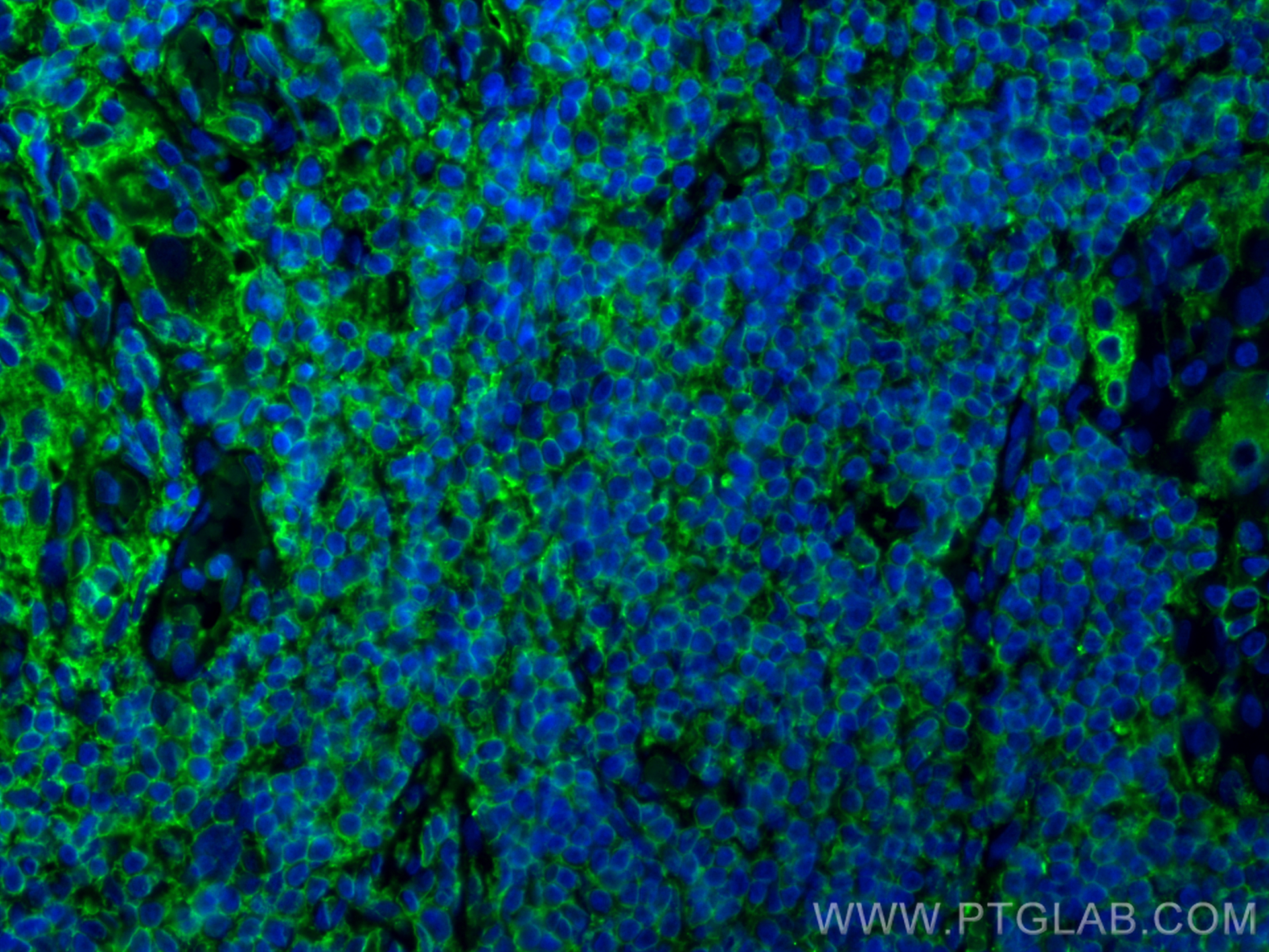 IF Staining of human thyroid cancer using 60272-1-Ig