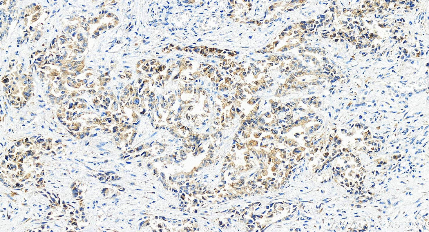 IHC staining of human intrahepatic cholangiocarcinoma using 83167-5-RR (same clone as 83167-5-PBS)