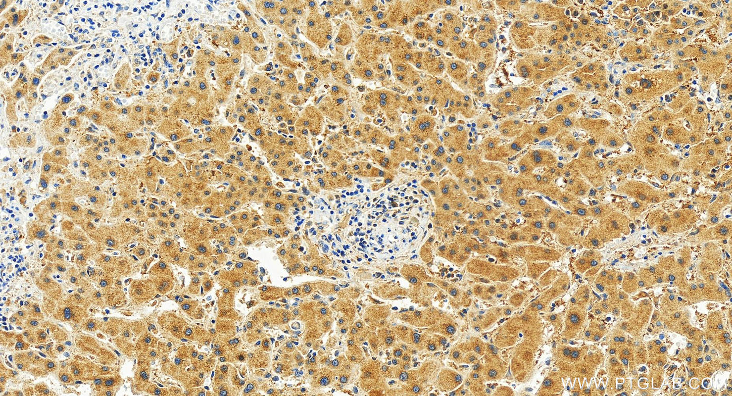 IHC staining of human intrahepatic cholangiocarcinoma using 83167-5-RR