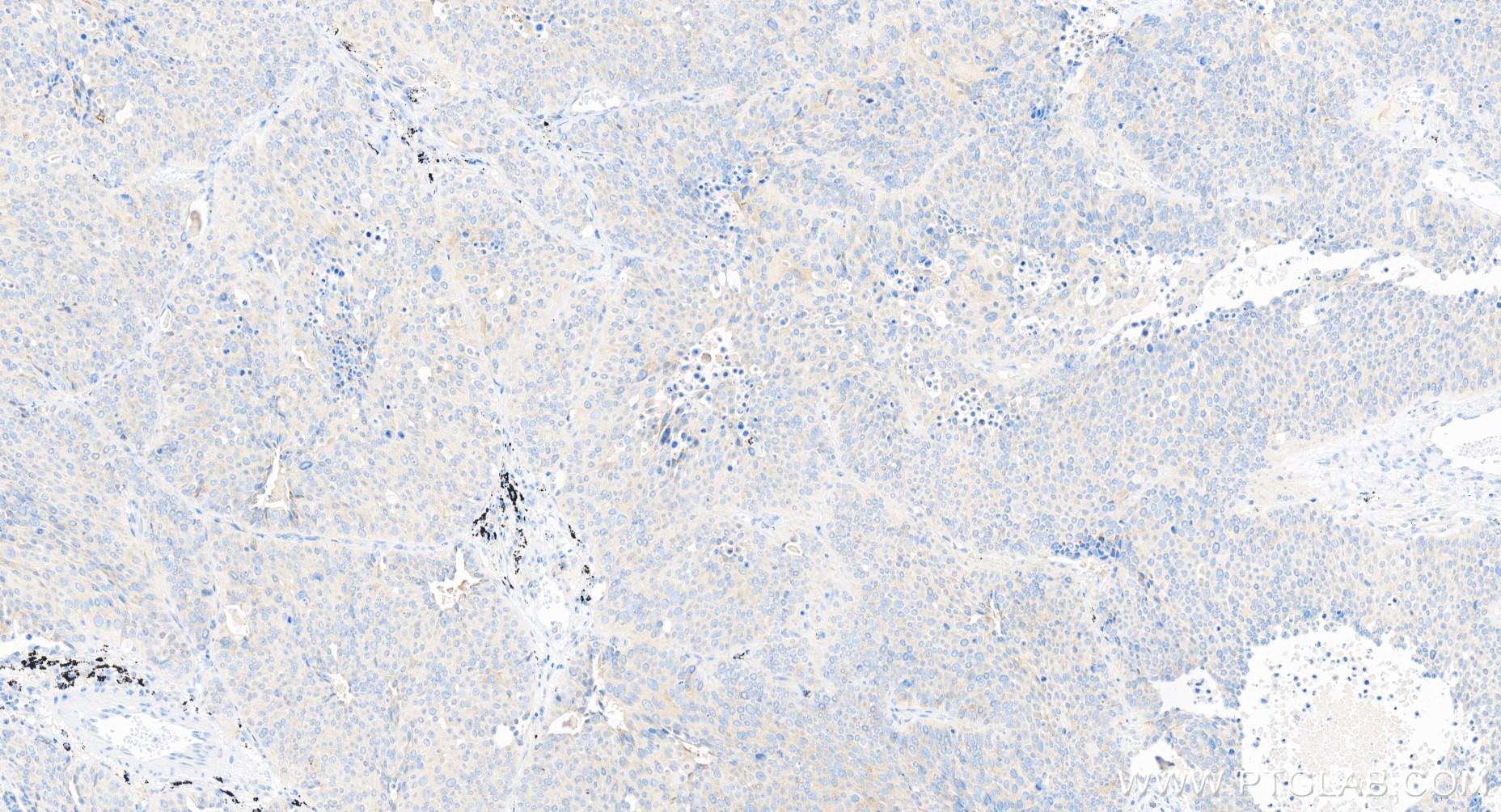 IHC staining of human lung cancer using 84453-1-RR