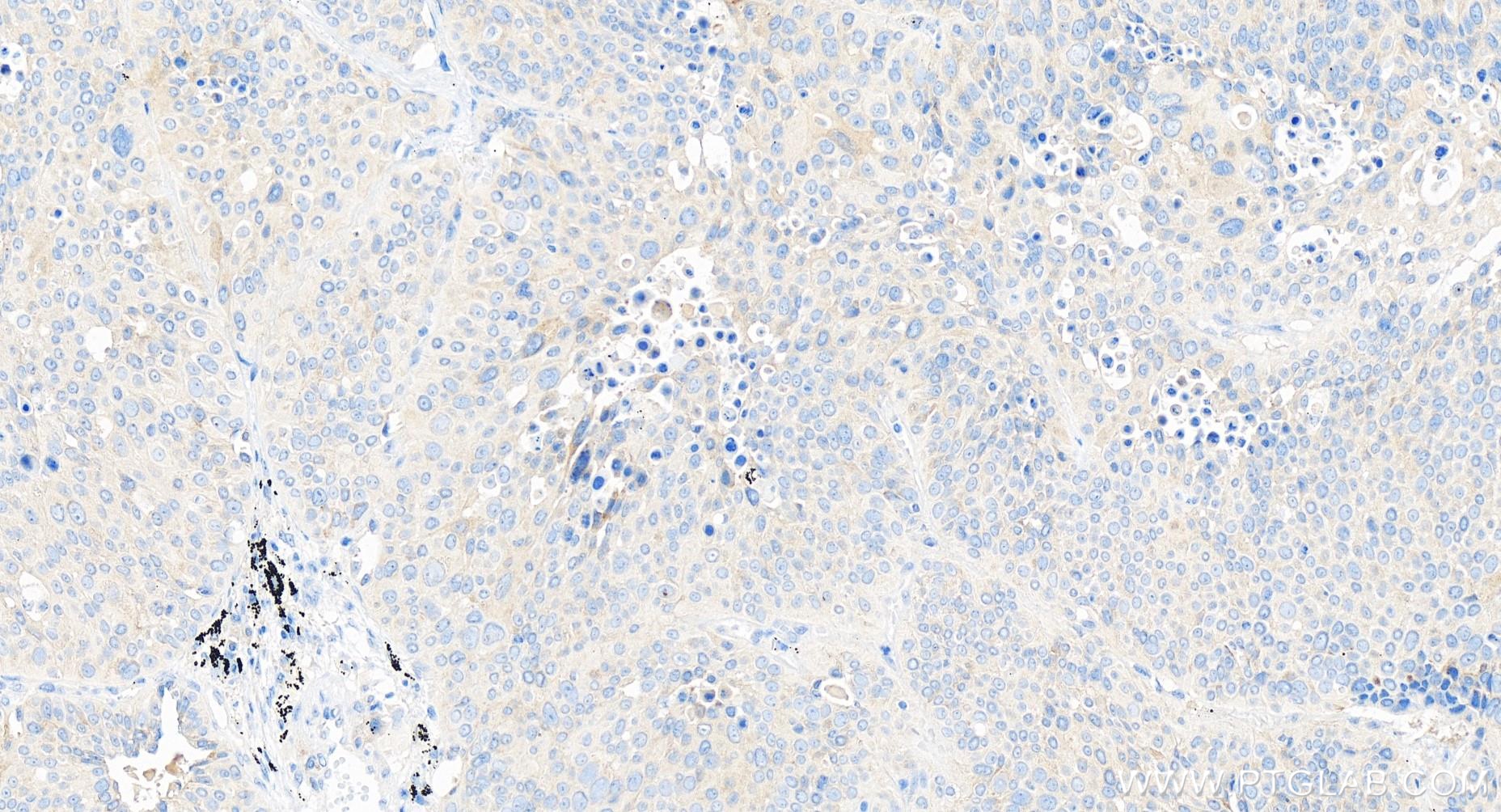 IHC staining of human lung cancer using 84453-1-RR