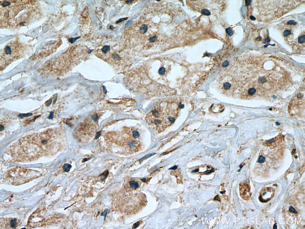 IHC staining of human breast cancer using 66636-1-Ig (same clone as 66636-1-PBS)