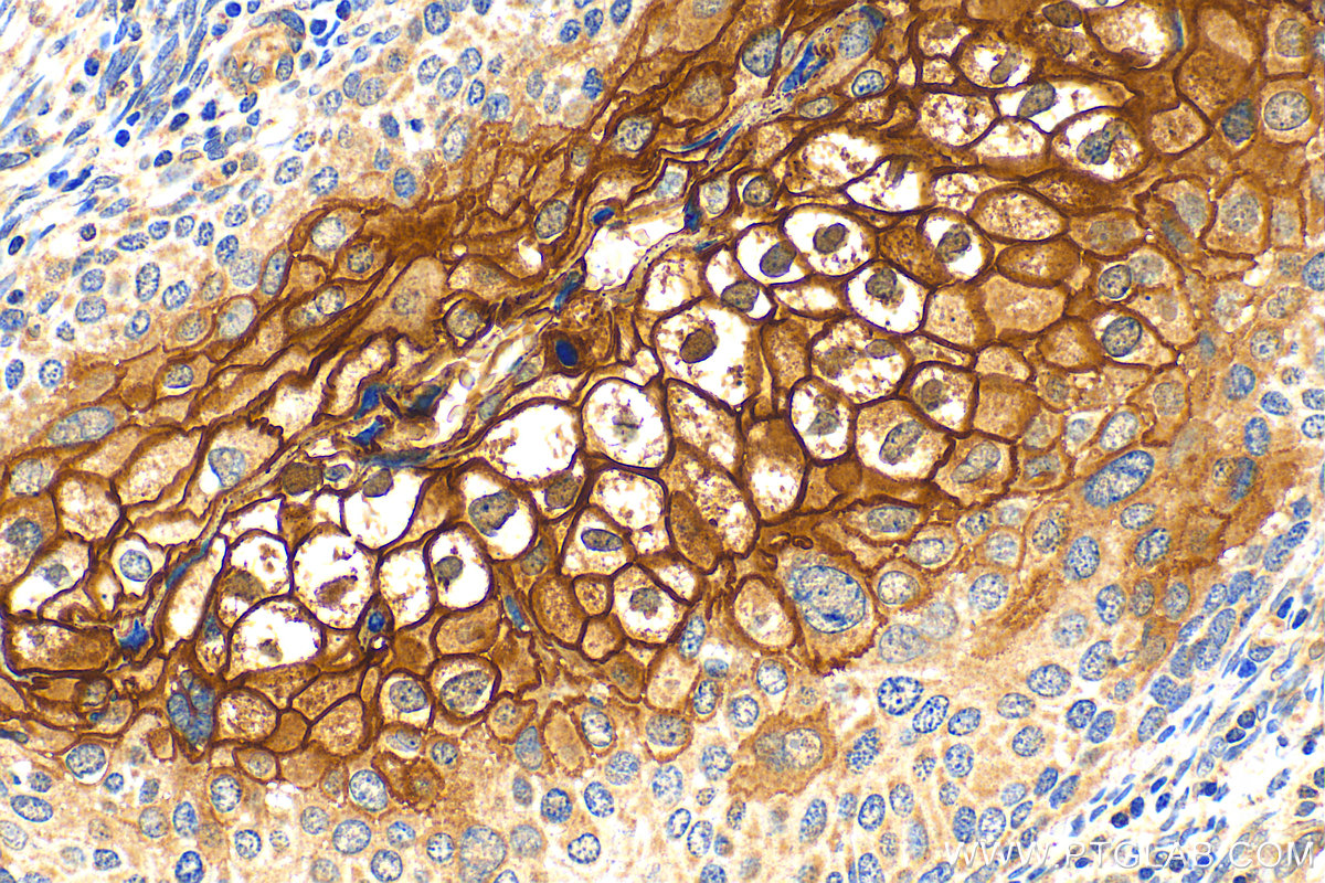IHC staining of human cervical cancer using 12912-3-AP