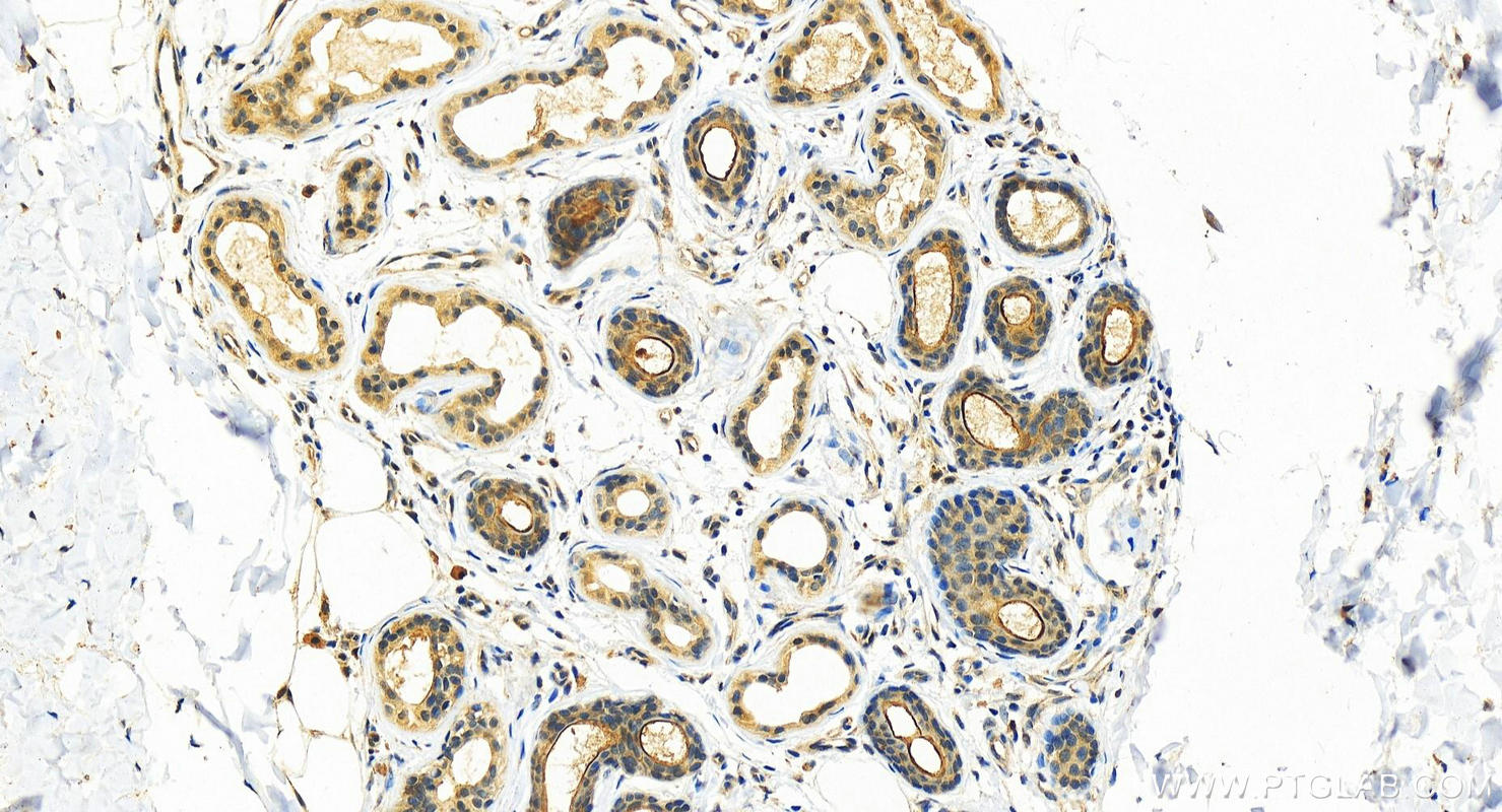 IHC staining of human bowen disease using 12912-3-AP