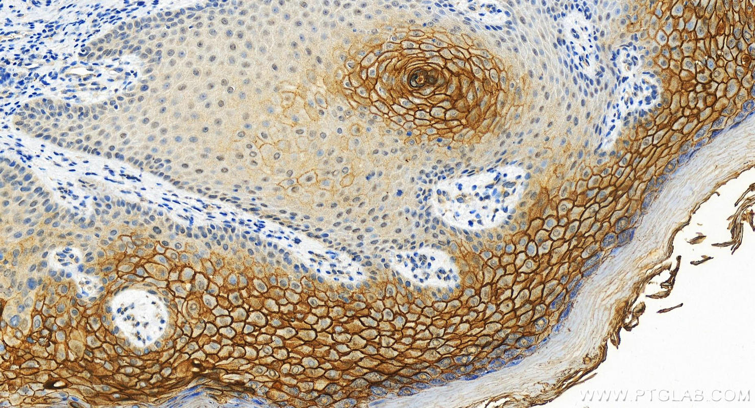 IHC staining of human bowen disease using 12912-3-AP