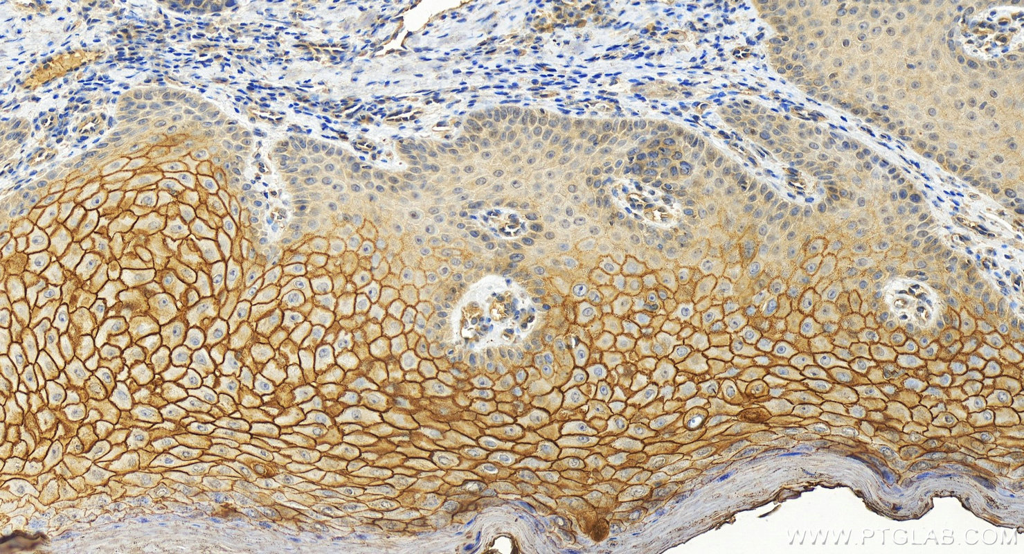 IHC staining of human brown disease using 12912-3-AP