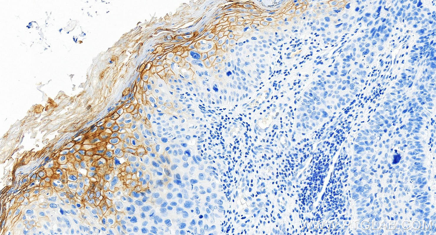 IHC staining of human bowen disease using 84032-2-RR (same clone as 84032-2-PBS)