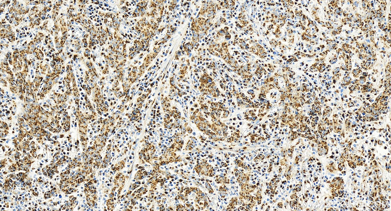 IHC staining of human stomach cancer using 83099-2-RR (same clone as 83099-2-PBS)