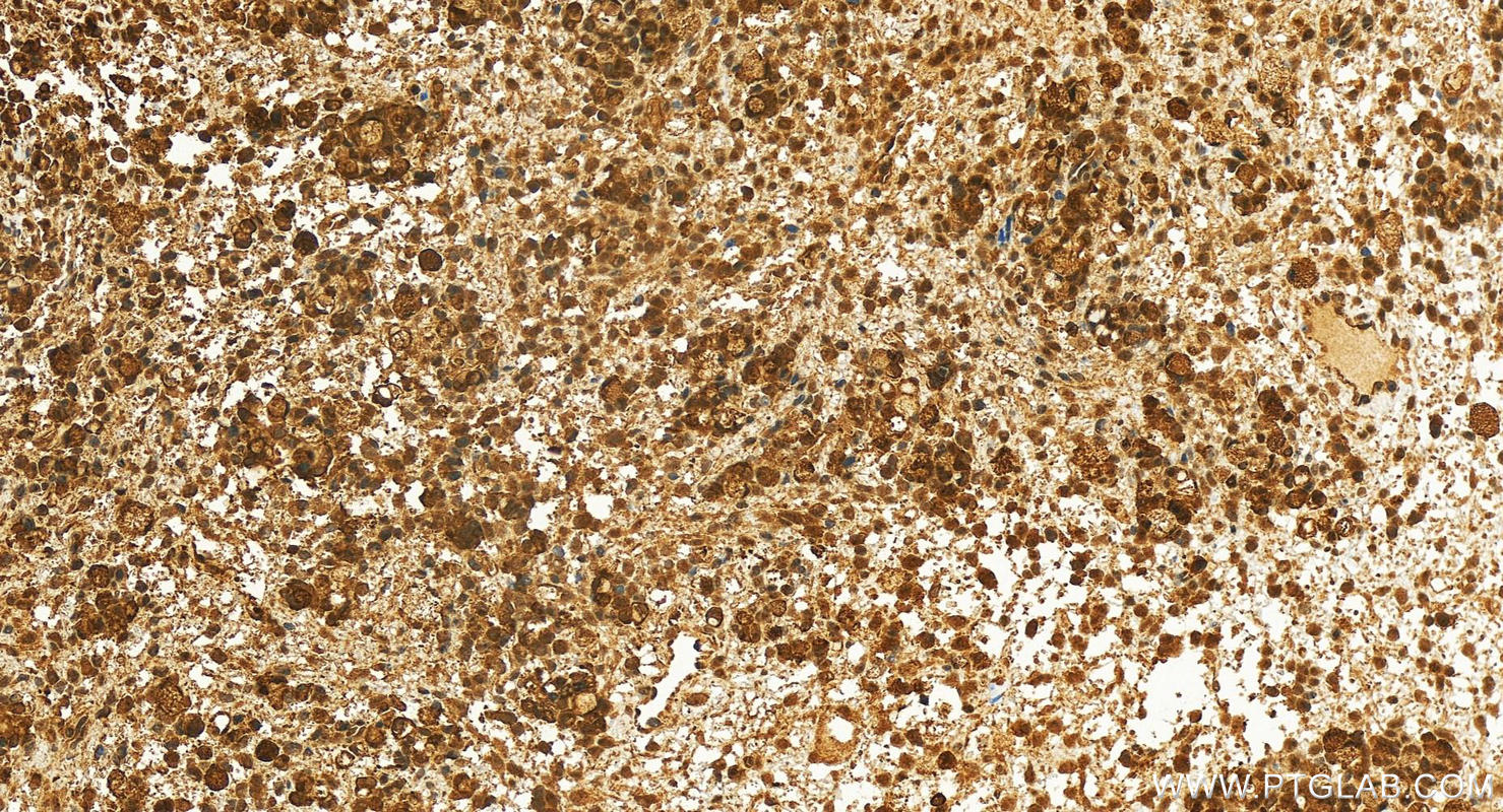 IHC staining of human ovary cancer using 13034-1-AP